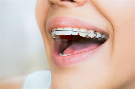 orthodontist baguio|Orthodontic Retainer in Baguio City, Philippines .